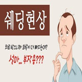 탈모정보 공유 핀페시아 에프페시아 미녀와탈모