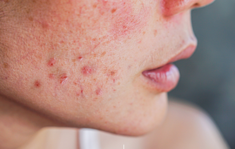 여드름약 정신병 위험은 기우...이소트레티노인 위험 없어 [출처: 메디컬 타임즈]